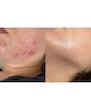 ژل ضد جوش دیفرین
