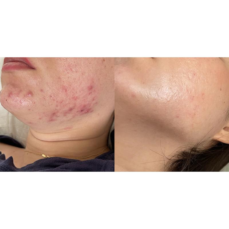 ژل ضدجوش دیفرین Differin