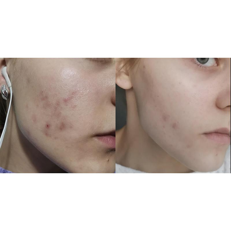 ژل ضدجوش دیفرین Differin