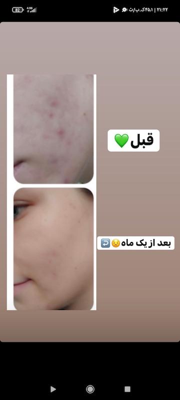 سرم ضدجوش چای سبز بیواکوا اورجینال
