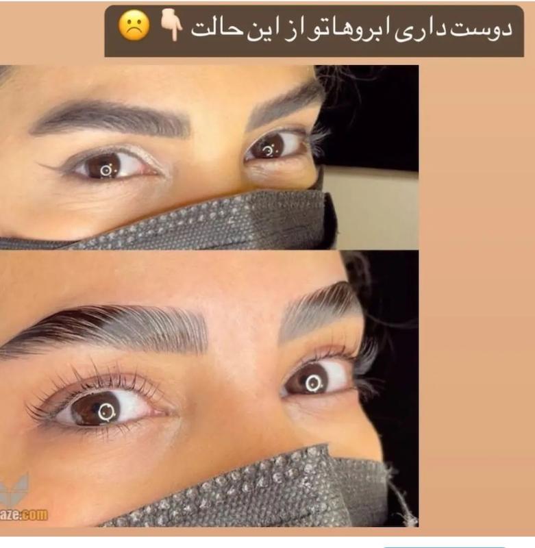ژل لیفت مورلی