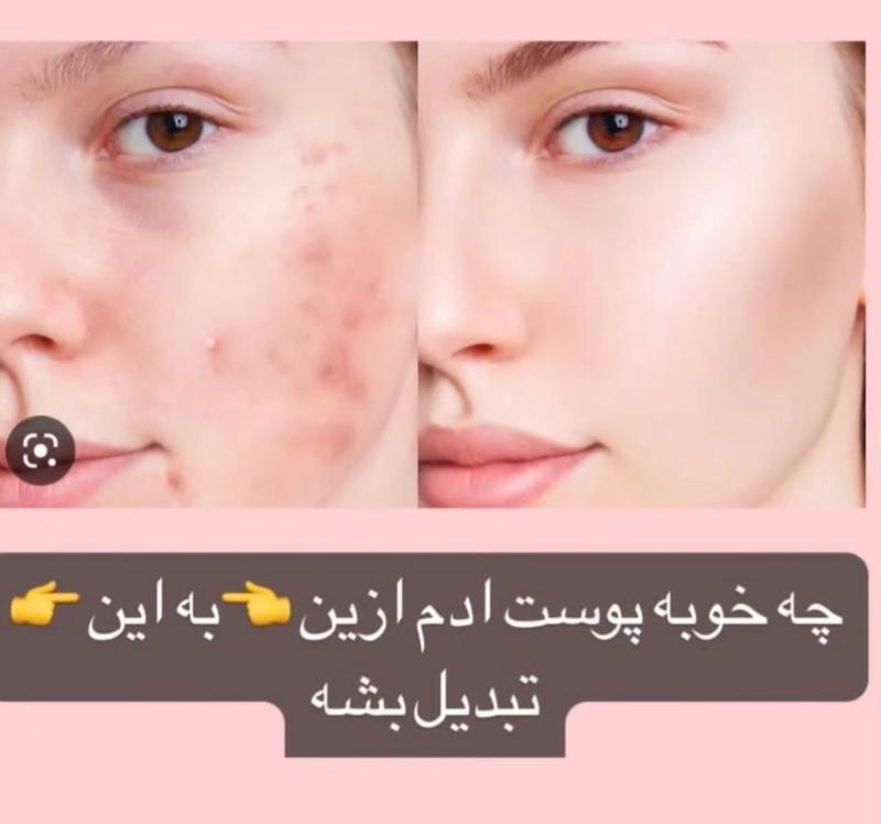 سرم سالیسیلیک اسید بیوآکوا