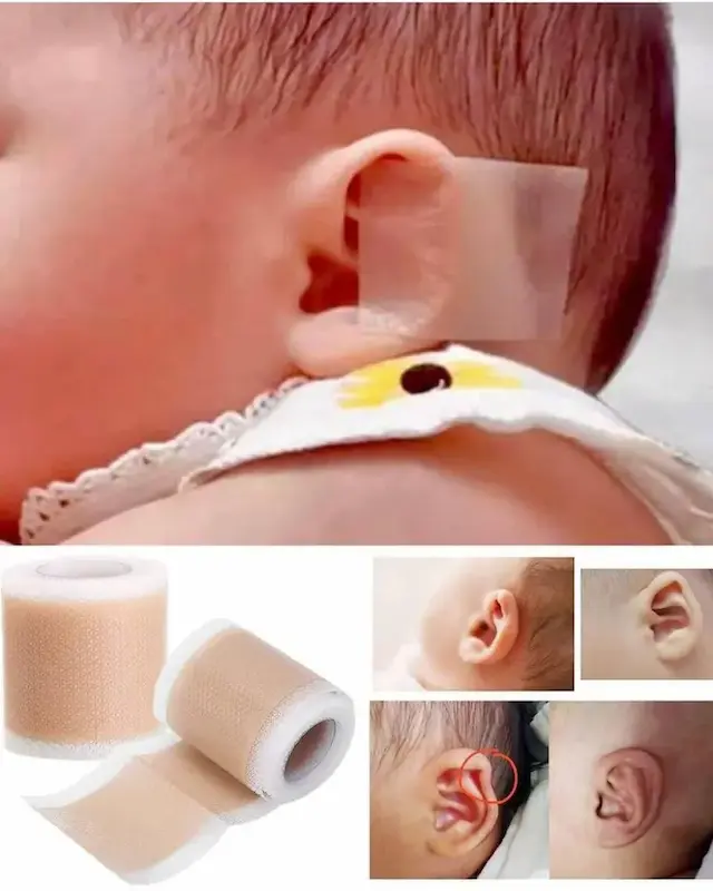 چسب فرمدهی گوش نوزاد بسته ۲ عددی