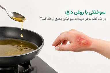 سوختگی با روغن داغ؛ چرا یک پاشش کوچک می‌تواند جدی باشد؟
