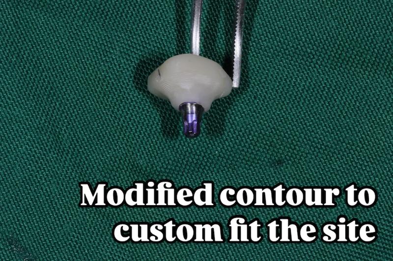 شابلون سیلیکونی ساخت کاستومایز هیلینگ و اباتمنت موقت Temporary Abutment و ... فرم‌دهنده لثهٔ (gingival former)