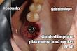 شابلون سیلیکونی ساخت کاستومایز هیلینگ و اباتمنت و ... فرم‌دهنده لثهٔ (gingival former)