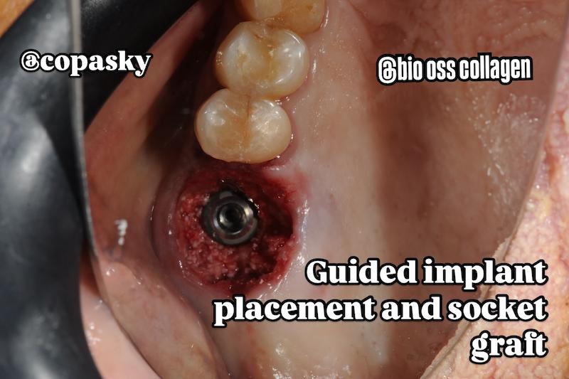 شابلون سیلیکونی ساخت کاستومایز هیلینگ و اباتمنت موقت Temporary Abutment و ... فرم‌دهنده لثهٔ (gingival former)