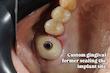 شابلون سیلیکونی ساخت کاستومایز هیلینگ و اباتمنت و ... فرم‌دهنده لثهٔ (gingival former)