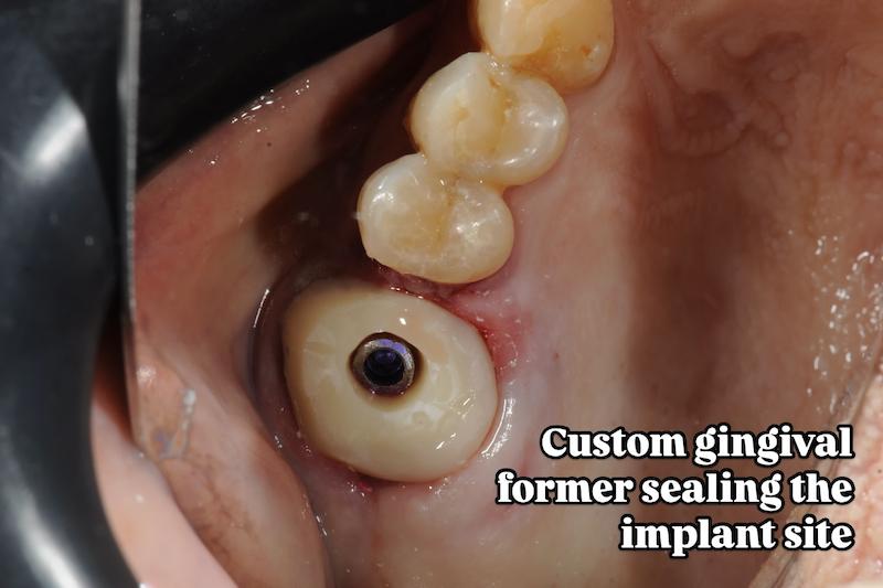 شابلون سیلیکونی ساخت کاستومایز هیلینگ و اباتمنت موقت Temporary Abutment و ... فرم‌دهنده لثهٔ (gingival former)