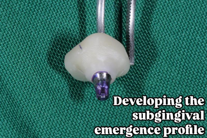 شابلون سیلیکونی ساخت کاستومایز هیلینگ و اباتمنت موقت Temporary Abutment و ... فرم‌دهنده لثهٔ (gingival former)