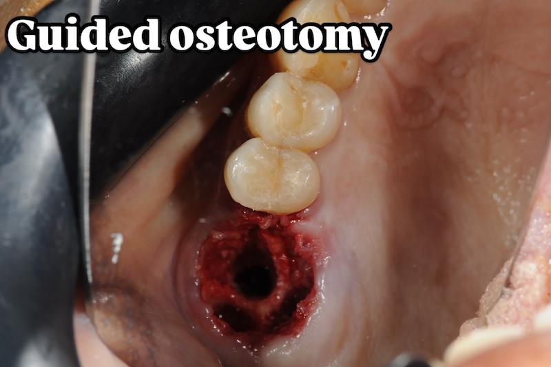 شابلون سیلیکونی ساخت کاستومایز هیلینگ و اباتمنت موقت Temporary Abutment و ... فرم‌دهنده لثهٔ (gingival former)
