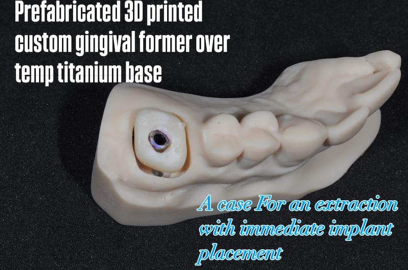 شابلون سیلیکونی ساخت کاستومایز هیلینگ و اباتمنت موقت Temporary Abutment و ... فرم‌دهنده لثهٔ (gingival former)