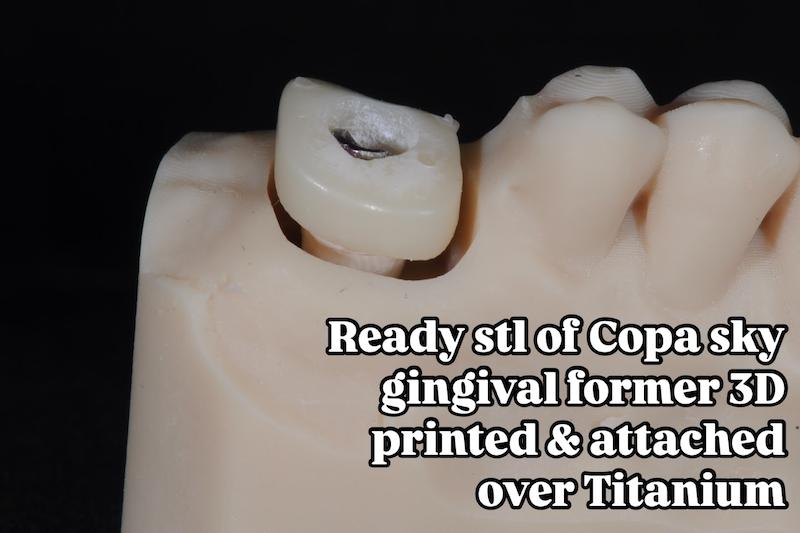 شابلون سیلیکونی ساخت کاستومایز هیلینگ و اباتمنت موقت Temporary Abutment و ... فرم‌دهنده لثهٔ (gingival former)