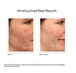 🎀درمان کننده جوش،لک و اسکار دکتر موراد    Dr murad InvisiScar Resurfacing Treatment    💎درمان لک و جای جوش در ۸ هفته💎