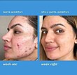 🎀درمان کننده جوش،لک و اسکار دکتر موراد    Dr murad InvisiScar Resurfacing Treatment    💎درمان لک و جای جوش در ۸ هفته💎