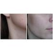 کرم ضد لک و ضد جوش بی د اسکین  Be The Skin Dark Spot Zero BHA+ Cream