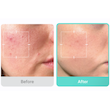 سرم آزلائیک اسید مدیکوب ضدقرمزی و تسکین دهنده  MEDICUBE Azelaic Acid 16% BB Calming Serum