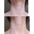 کرم لیفتینگ و ضد چروک گردن مدی پیل  Medi-Peel collagen naite thread