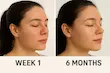 کرم ضد جوش و لک قوی آکرتین 0.05% تریتنوین  Jamjoom Pharma Acretin 0.05% Tretinoin For Acne Treatment Cream