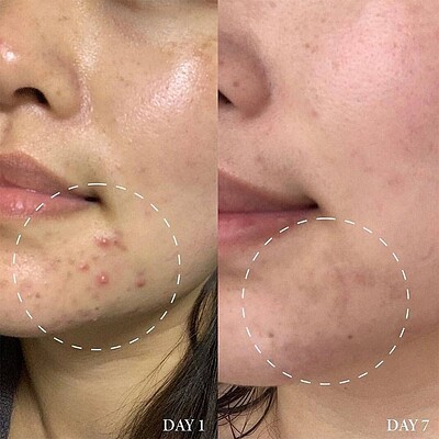 سرم ضد لک و جوش اکسیس وای Difference Blemish Treatment