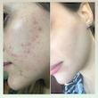 کرم و ژل ضد جوش بیوممتیک 