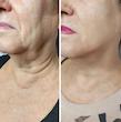 کرم ضد چروک گاتیو ۵ کاره و بوتاکس کننده | Gatieau Anti-Wrinkle Face Cream