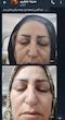 کرم ضد چروک گاتیو ۵ کاره و بوتاکس کننده | Gatieau Anti-Wrinkle Face Cream
