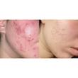 ژل دیفرین Adapalene 0.1% | درمان جوش و آکنه