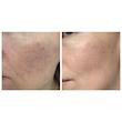 آمپول تسکین‌دهنده سنتلا SKIN1004 (اسکین 1004) Centella مناسب ترمیم و آرام‌سازی پوست 100 میل