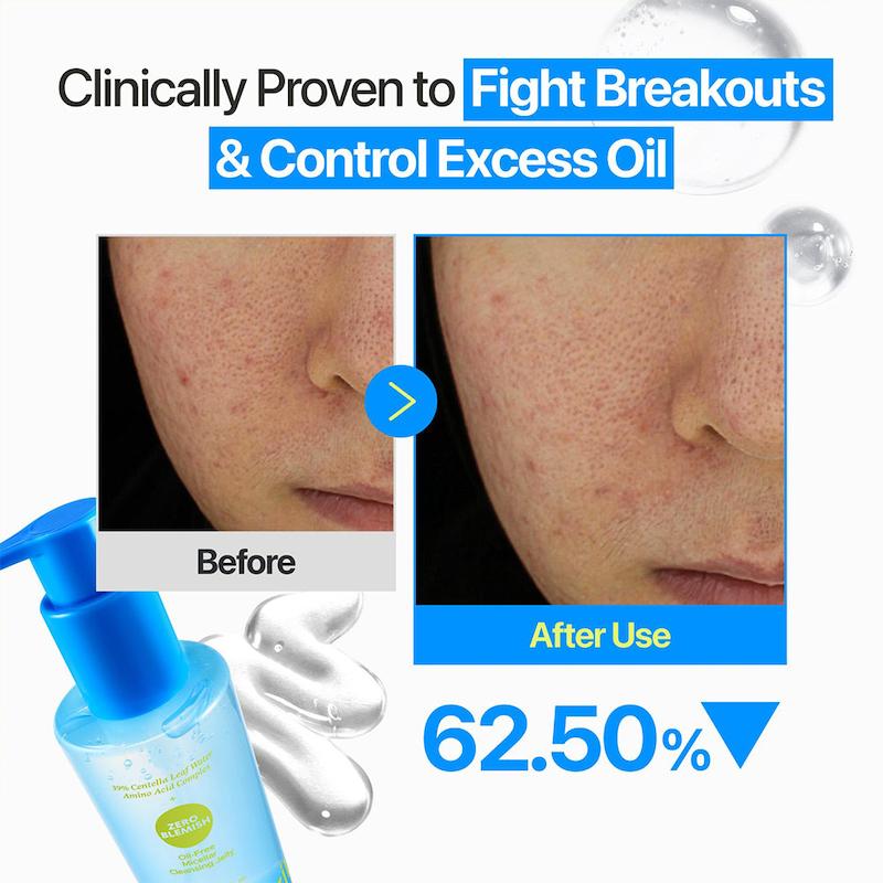 ژل میسلار بدون چربی نامبوزین (ضد جوش و پاک کننده عمقی )Numbuzin oil free Micellar ZERO BLEMISH