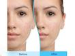 ژل ضدجوش دیفرین اورجینال🪞|Differin gel adapalene gel acne treatment