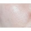 آمپول کنترل و کوچک کننده منافذ سنتلا ماداگاسکار اسکین 1004 🎀| Centella Poremizing Fresh Ampoule
