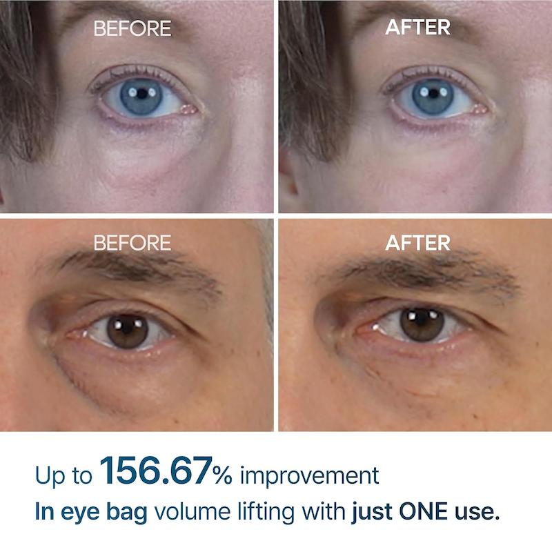 نتایج قبل و بعد استفاده از کرم دور چشم Dr.Melaxin Eyephalt برای بهبود ظاهر کیسه زیر چشم