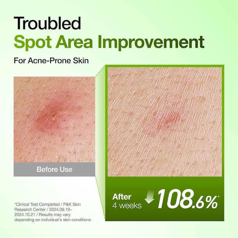 Anua Azelaic Acid 10 Hyaluron Redness Soothing Serum 30ml تست کاهش قرمزی و تسکین پوست