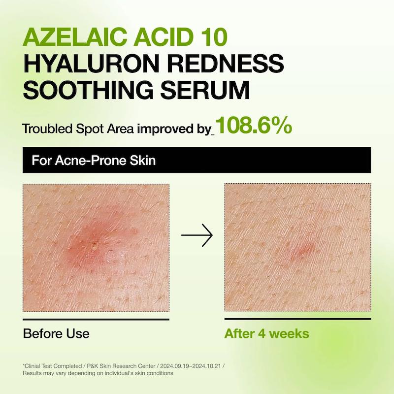 نتایج استفاده از سرم Azelaic Acid 10 Hyaluron آنوا برای بهبود ظاهر قرمزی پوست