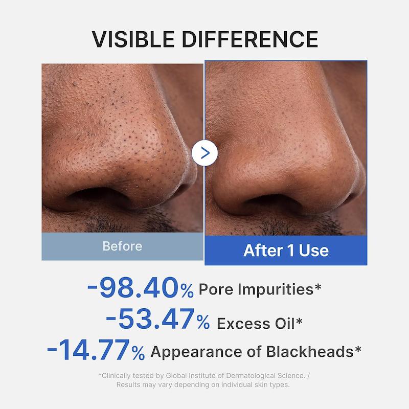 نتیجه استفاده از ماسک مدیکوب Zero Pore Blackhead در کاهش جوش‌های سرسیاه و ظاهر منافذ