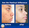 شوینده ضد جوش پاناکسیل اصل PanOxyl