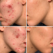 ژل ضد جوش اداپالن دیفرین Adapalene Gel anti acne differin