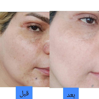رفع لک صورت به روش‌های گیاهی؛ راهکارهای طبیعی برای پوستی شفاف
