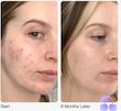 کرم گلوتاتیون نیاسینامید APLB ضد لک و روشن کننده قوی پوست APLB Glutathione Niacinamide Facial Cream