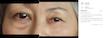 کرم دور چشم ضد چروک و رفع پف دکتر ملاکسین مدل Eyephalt