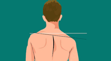 شایع ترین ناهنجاری اسکلتی در دنیا و حرکات اصلاحی 