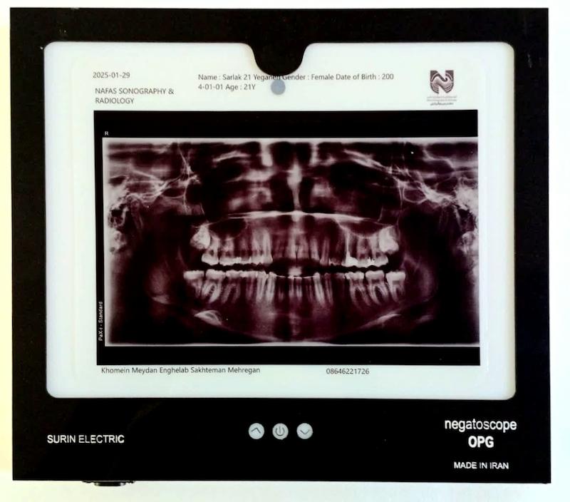 مینی  نگاتوسکوپ پزشکی opg برند surinelctric 