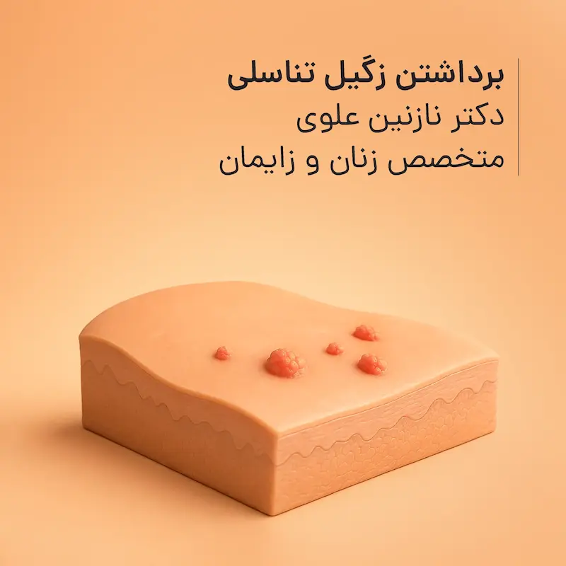 برداشتن زگیل تناسلی مطب دکتر نازنین علوی