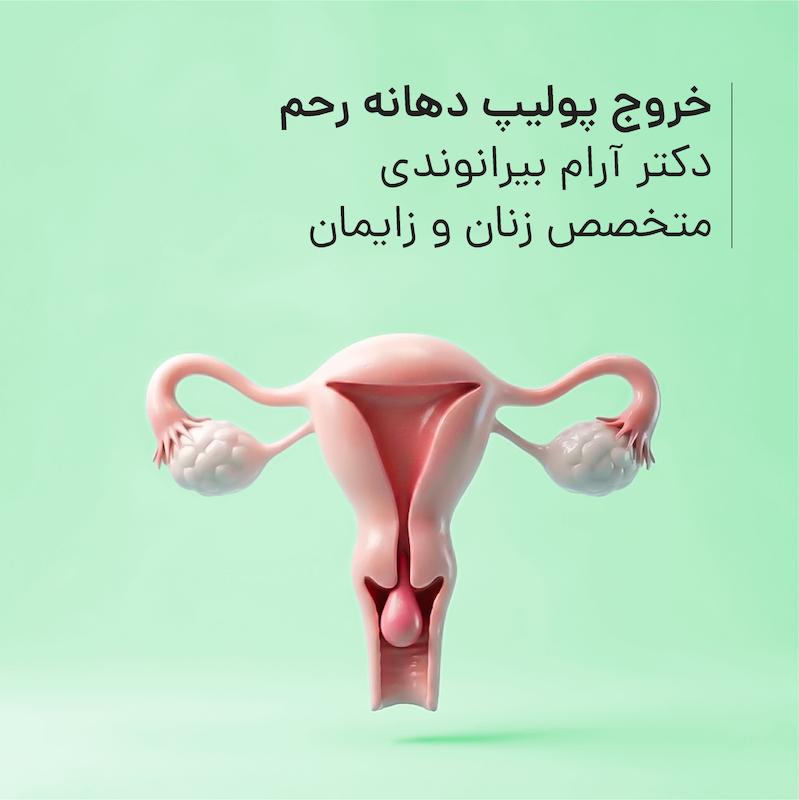خروج پولیپ دهانه رحم مطب دکتر آرام بیرانوندی