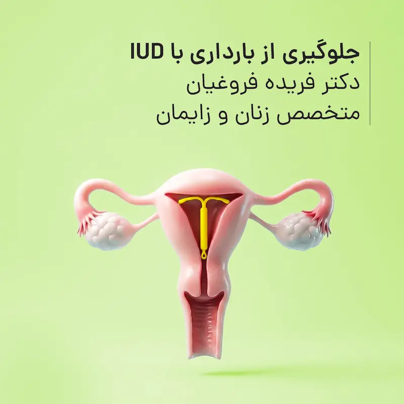 جلوگیری از بارداری با IUD مطب دکتر فریده فروغیان