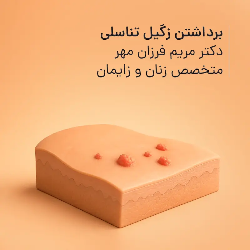 برداشتن زگیل تناسلی مطب دکتر مریم فرزان‌مهر