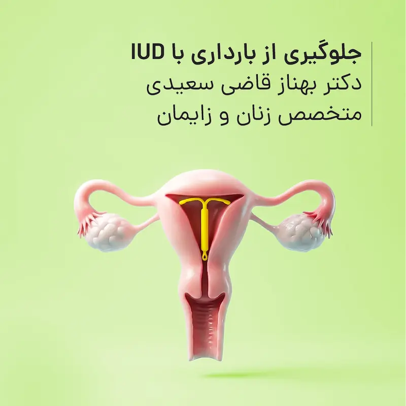 جلوگیری از بارداری با IUD مطب دکتر بهناز قاضی سعیدی