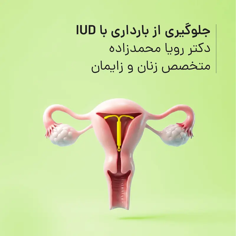 جلوگیری از بارداری با IUD مطب دکتر رویا محمدزاده