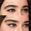 کش لیفت شقیقه